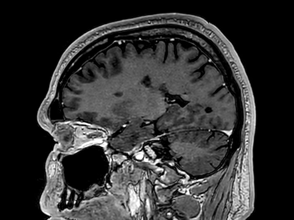 Sagittal 3D T1w TFE<b>Post-Gado</b>