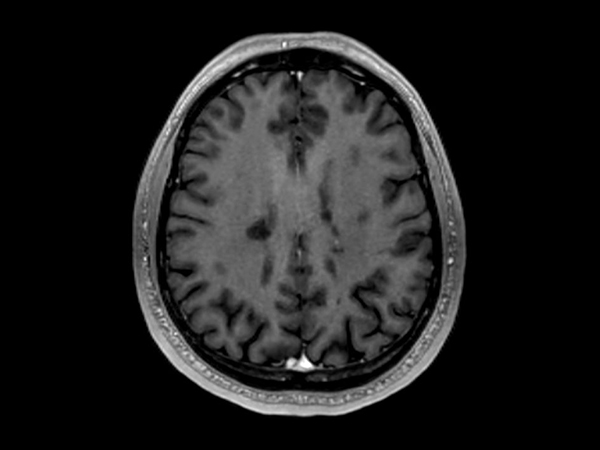 3D T1w TFE (Axial reformat)<b>Post-Gado</b>