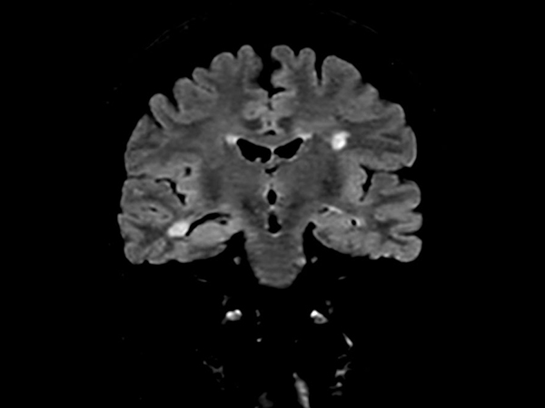 3D FLAIR (Coronal reformat)