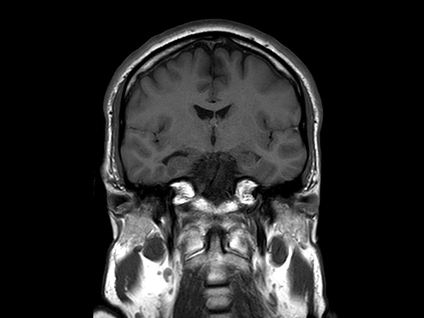 Coronal T1w SE<b>Pre-Gado</b>