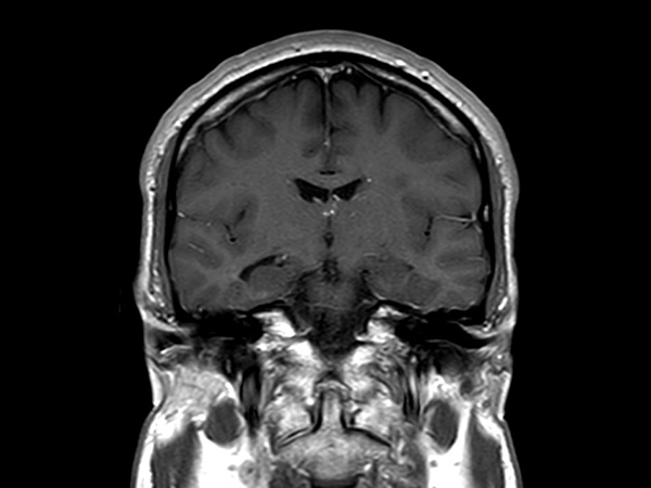 Coronal T1w SE<b>Post-Gado</b>