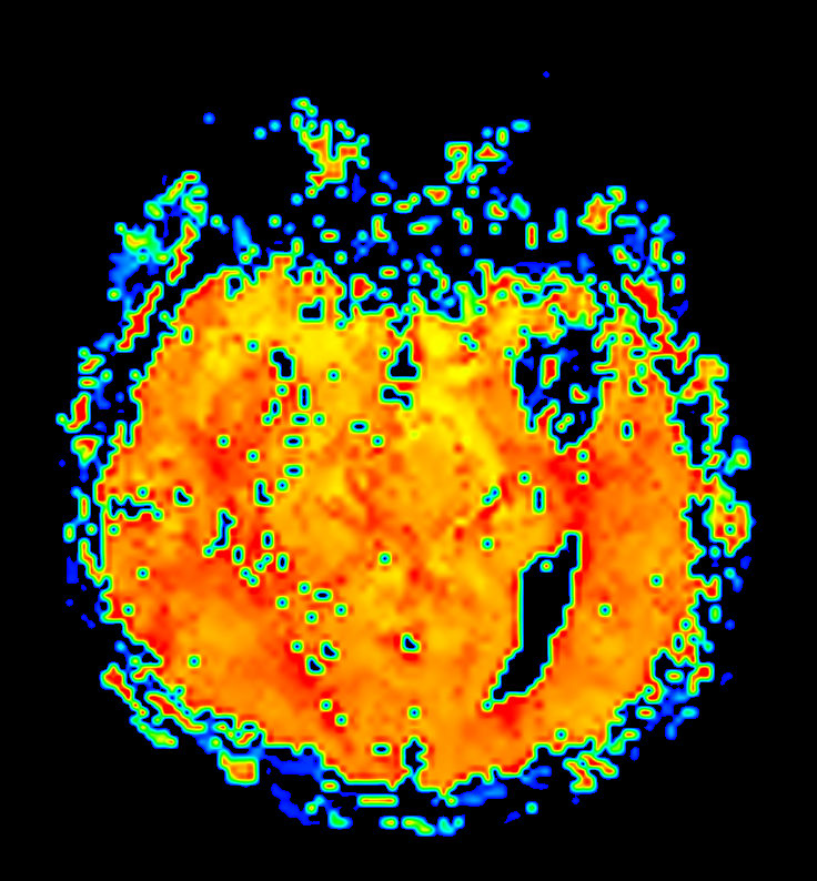 Axial T2* Perfusion (TTP)