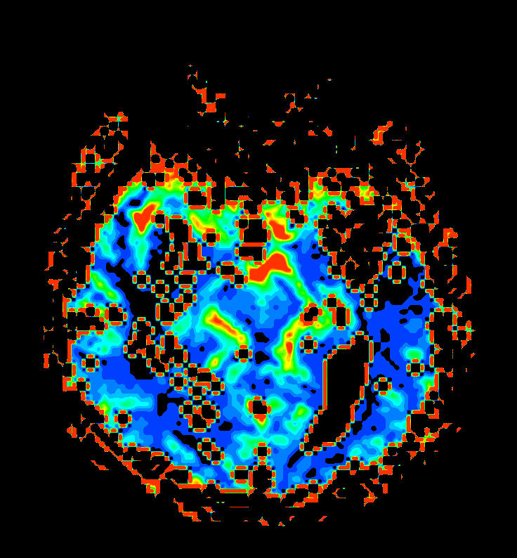 Axial T2* Perfusion (NI)