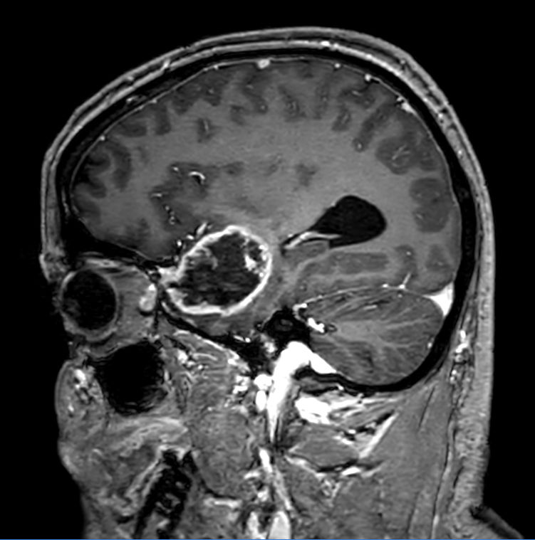 Sagittal 3D T1w TFE<b>Post-Gado</b>