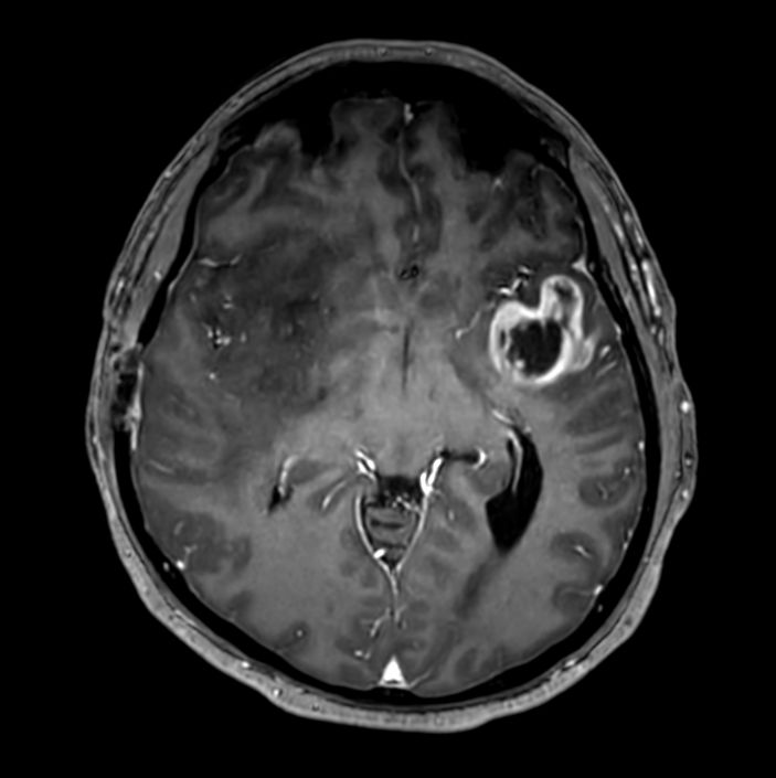 3D T1w TFE (Axial reformat)<b>Post-Gado</b>