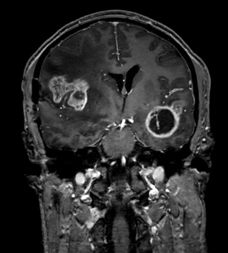 3D T1w TFE (Coronal reformat)<b>Post-Gado</b>
