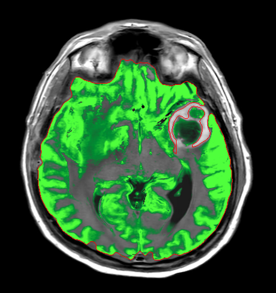 Axial SyntAc (Grey Matter)