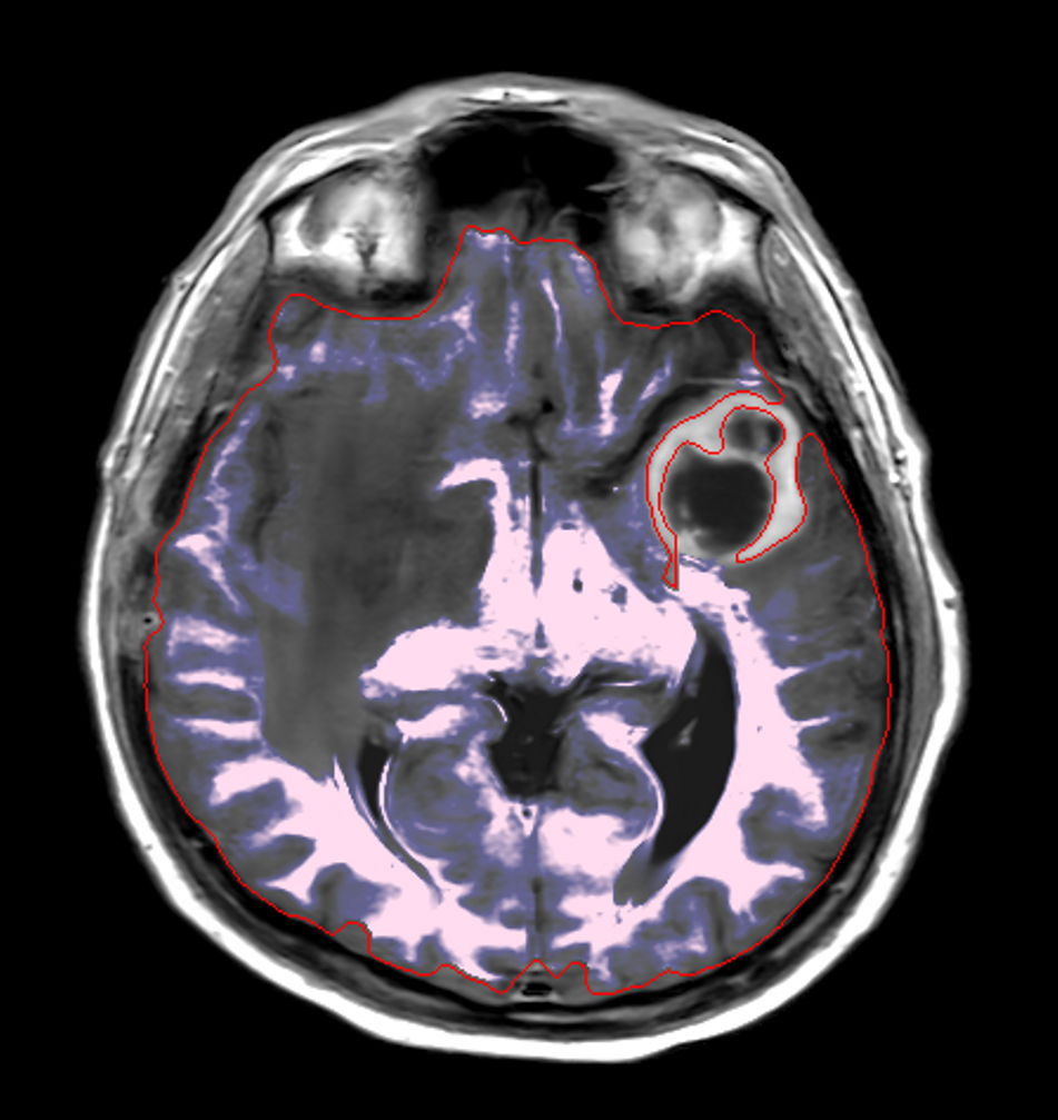 Axial SyntAc (White Matter)