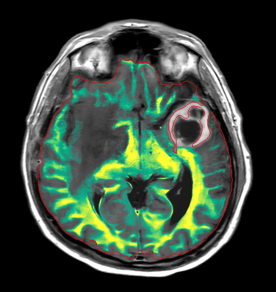 Axial SyntAc (Myelin)