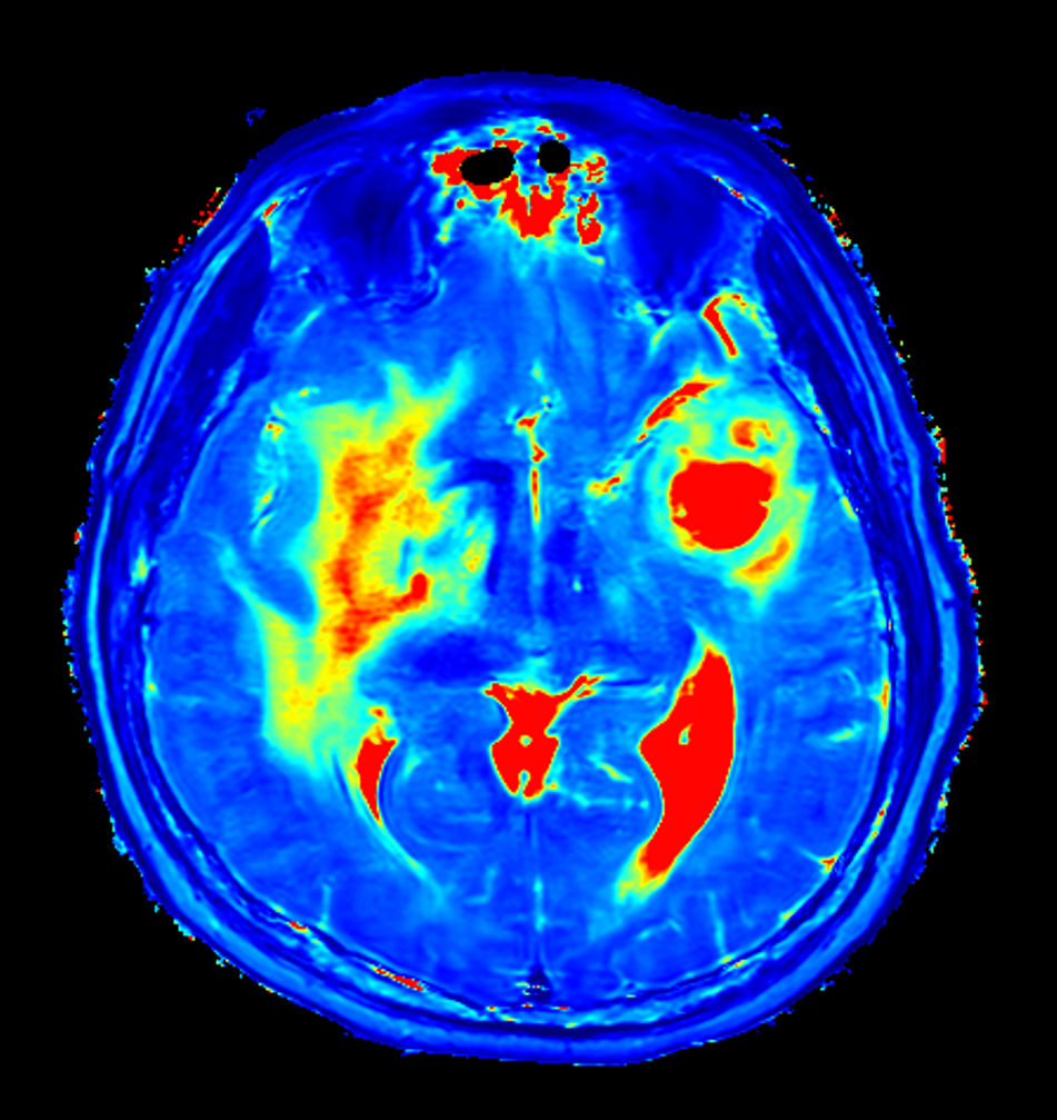 Axial SyntAc (T2 Map)