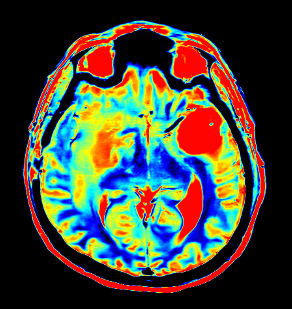Axial SyntAc (PD Map)