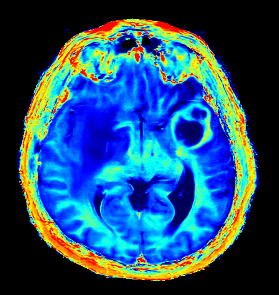 Axial SyntAc (R1 Map)