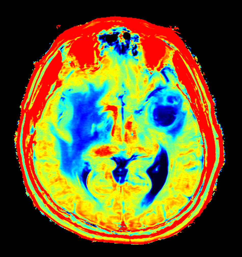 Axial SyntAc (R2 Map)