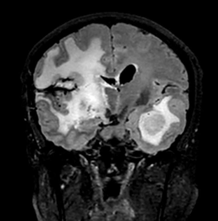 3D FLAIR (Coronal reformat)