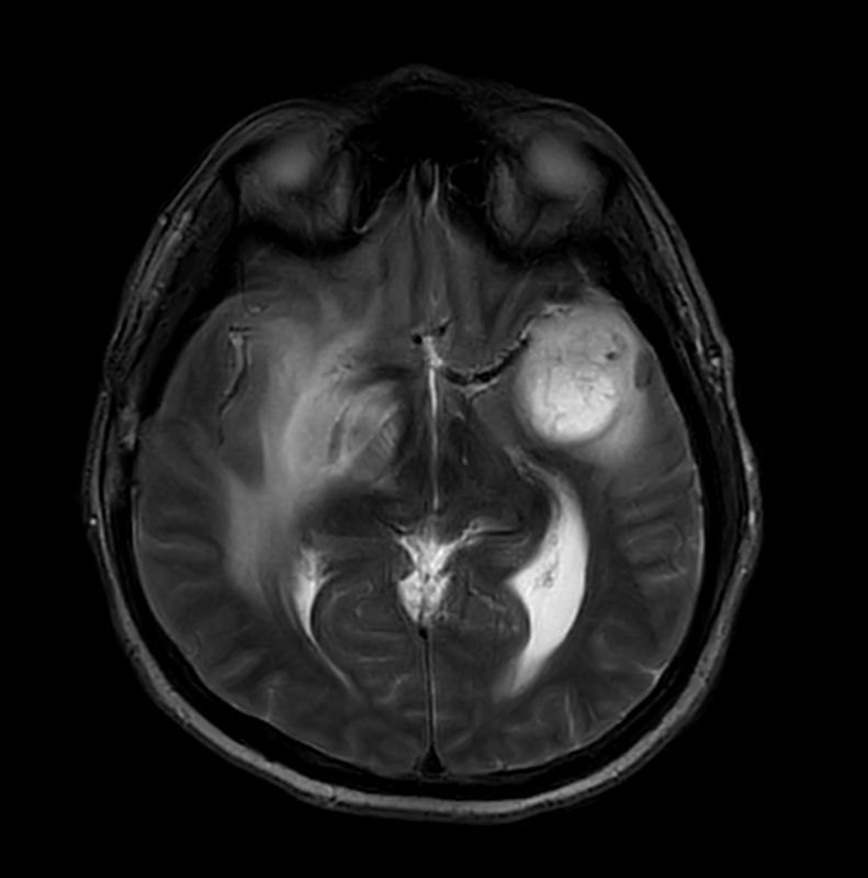 Axial T2w TSE Motion-Free