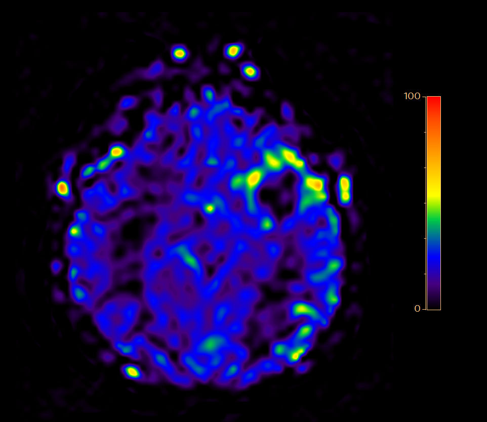 Axial 3D pCASL (3 dynamics)