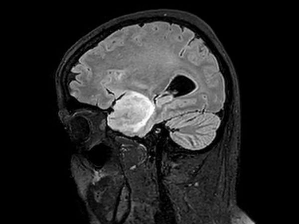 Sagittal 3D FLAIR