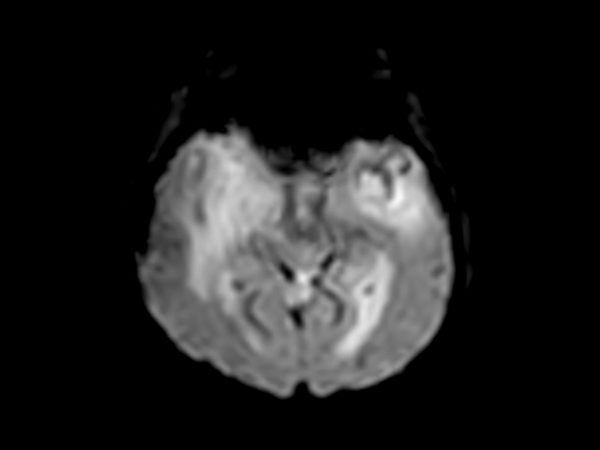 Axial T2* Perfusion (60 dynamics)