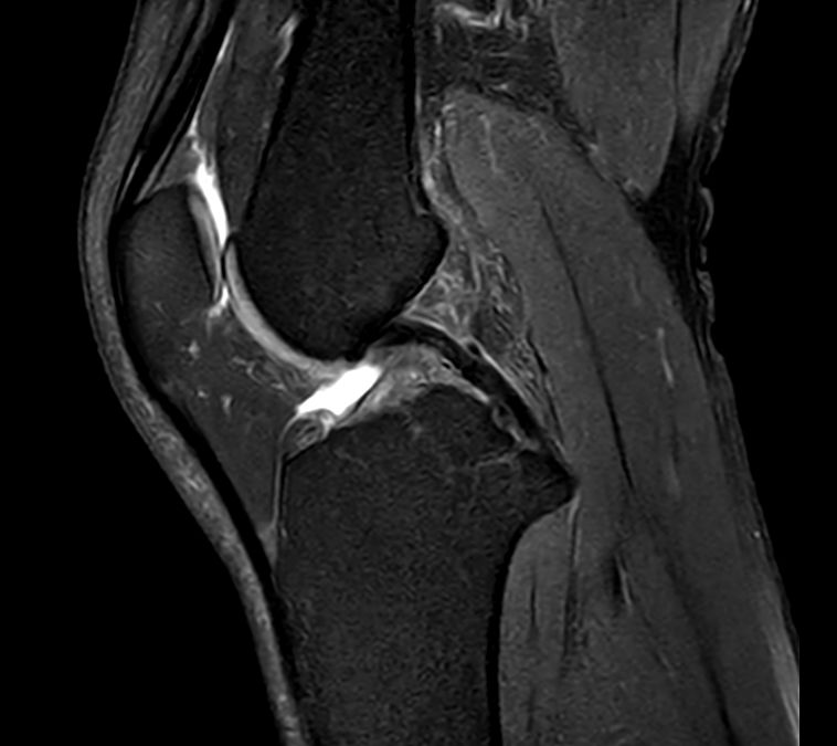 Sagittal PDw TSE FatSat