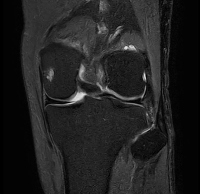 Coronal PDw TSE FatSat