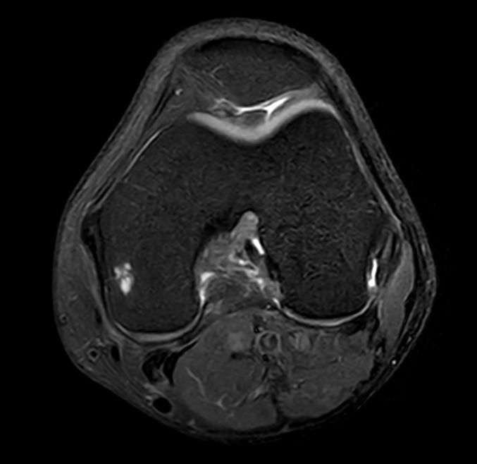 Axial PDw TSE FatSat