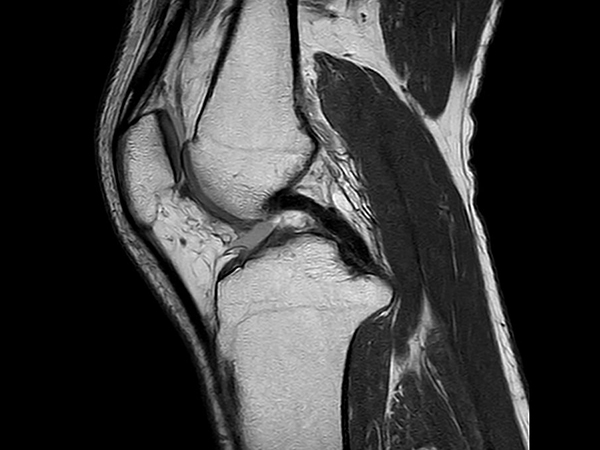 Sagittal PDw TSE