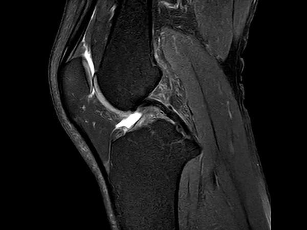 Sagittal PDw TSE FatSat