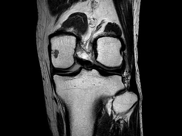 Coronal PDw TSE