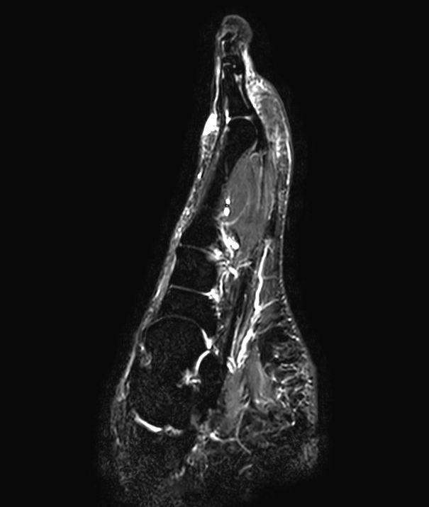 Sagittal STIR TSE