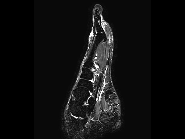 Sagittal STIR TSE