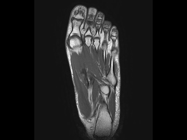 Coronal T1w TSE