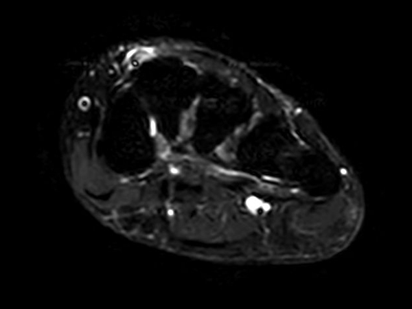 Axial STIR TSE