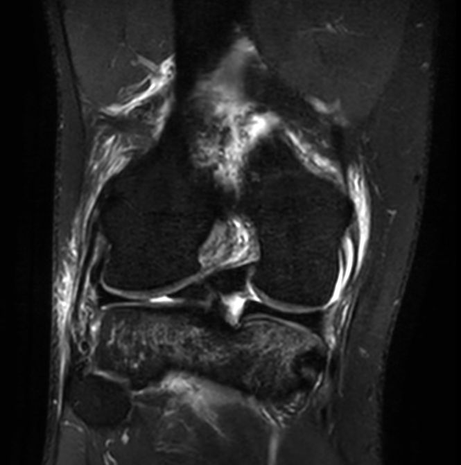 3D PDw TSE FatSat (coronal reformat)