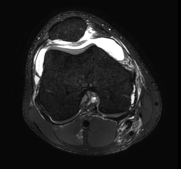 3D PDw TSE FatSat (axial reformat)