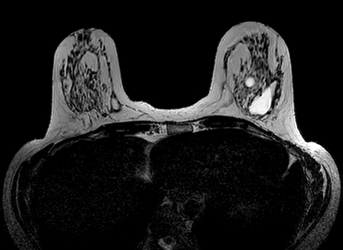 Axial 3D T2w BreastVIEW