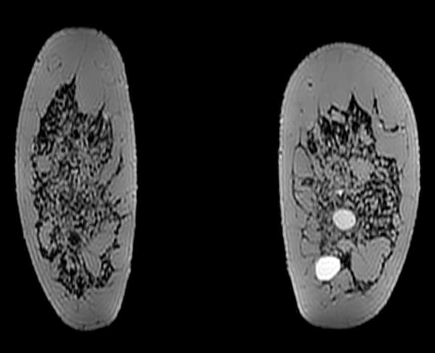 3D T2w BreastVIEW (coronal reformat)