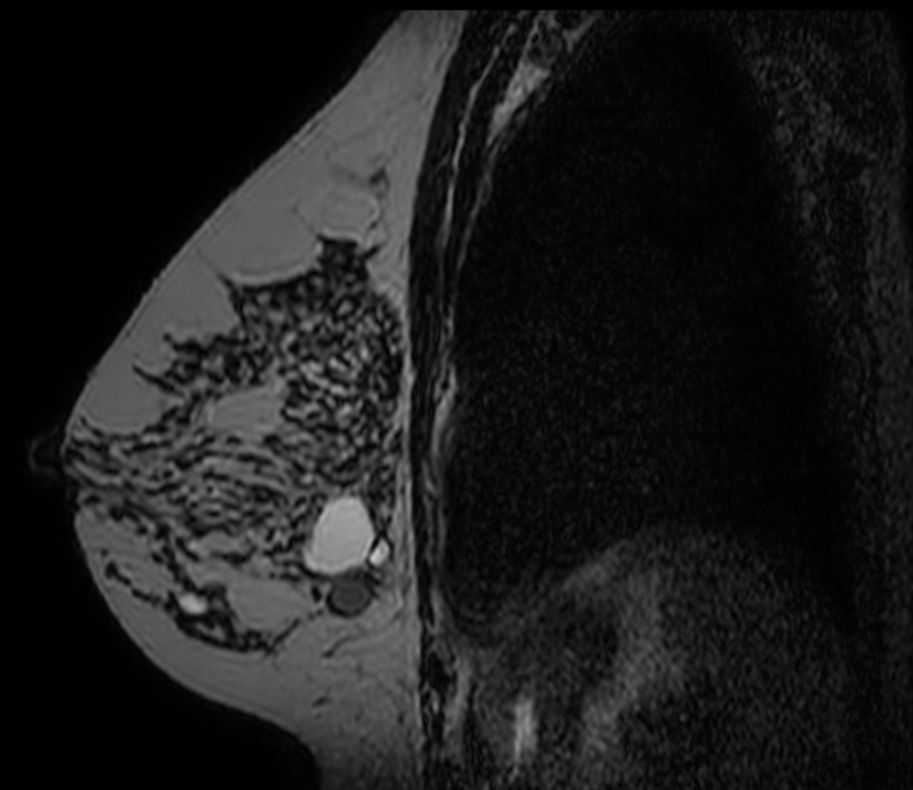 3D T2w BreastVIEW (sagital reformat)