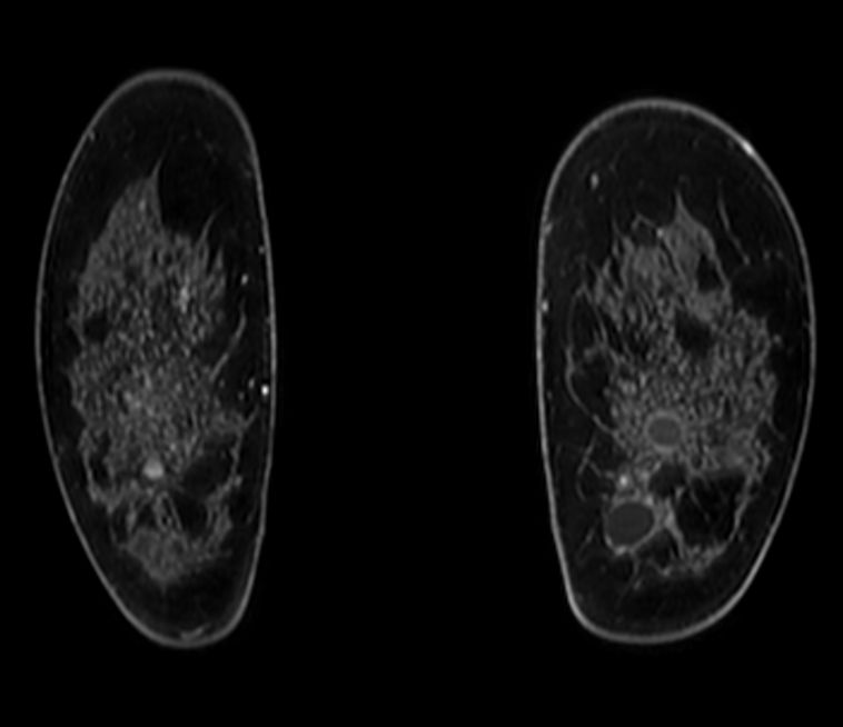 3D VANE XD (coronal reformat)