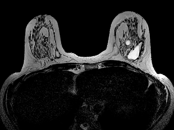 Axial 3D T2w BreastVIEW