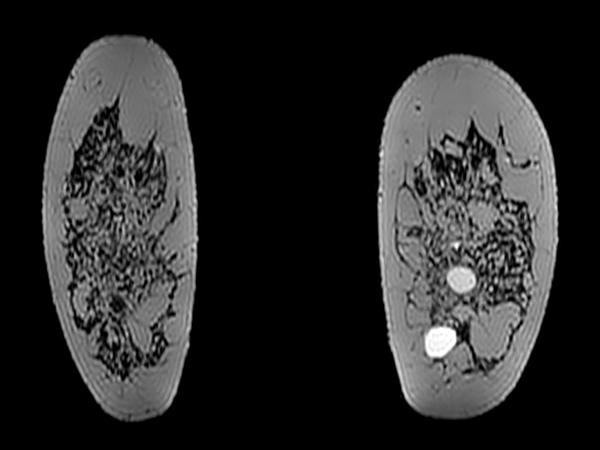 3D T2w BreastVIEW (coronal reformat)