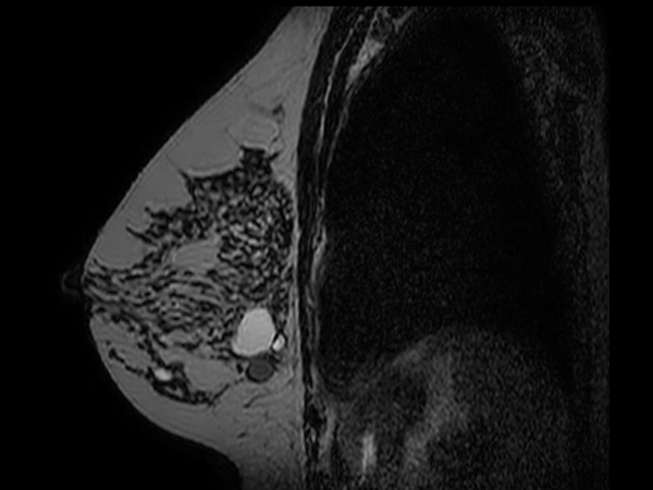 3D T2w BreastVIEW (sagital reformat)