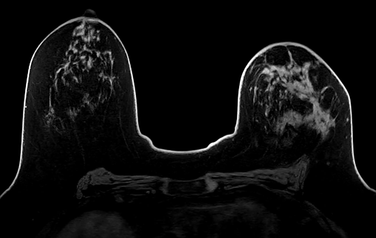 Axial T1w FFE mDIXON