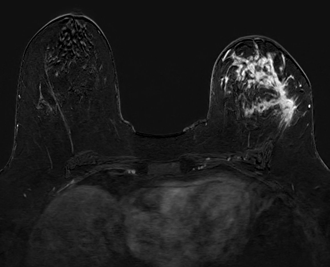 Axial dynamic T1w FFE (subtraction)