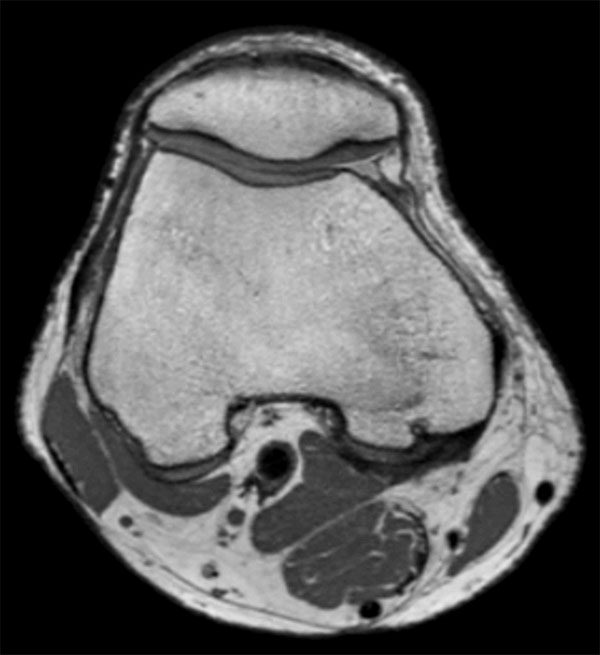 MSK View PDw TSE Axial Reformat