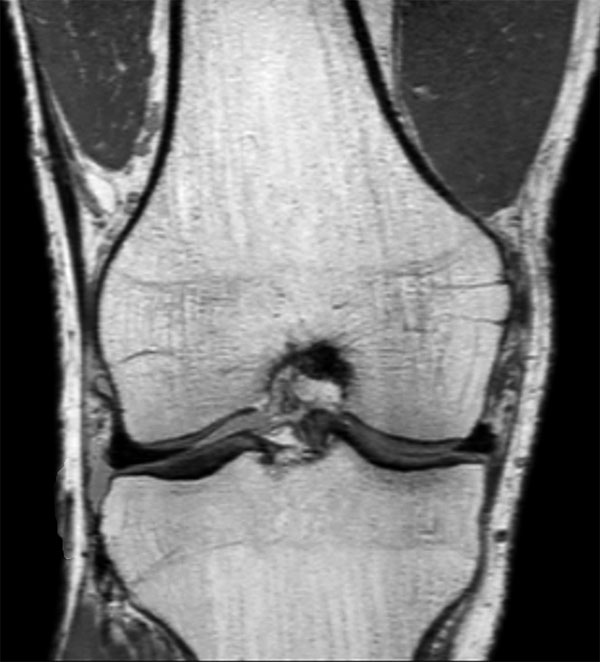 MSK View PDw TSE Coronal Reformat