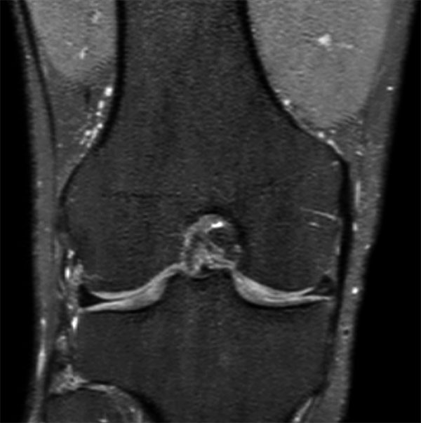 MSK View PDw SPAIR Coronal Reformat