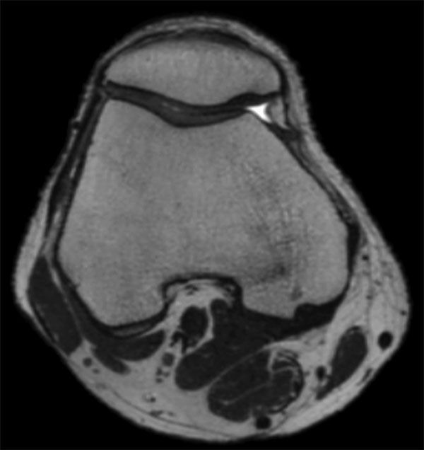 MSK View T2w TSE Axial Reformat