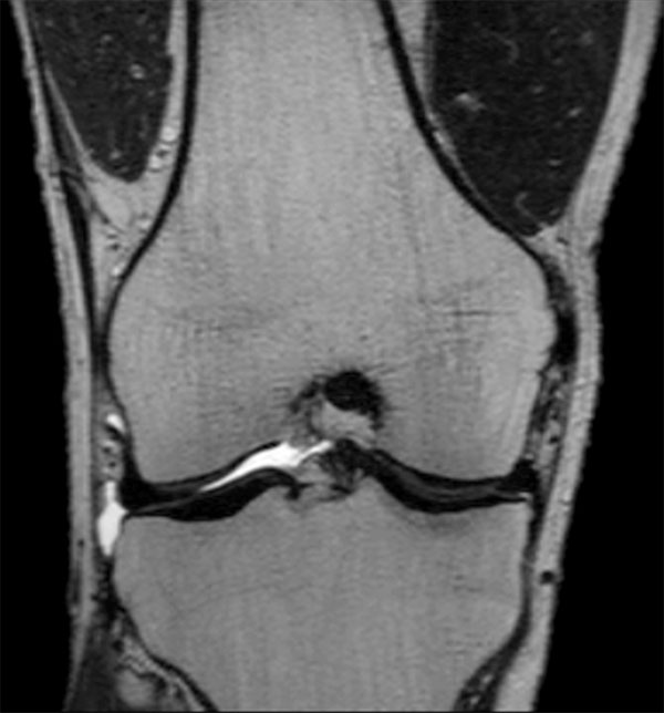 MSK View T2w TSE Coronal Reformat