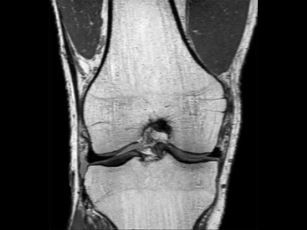 MSK View PDw TSE Coronal Reformat