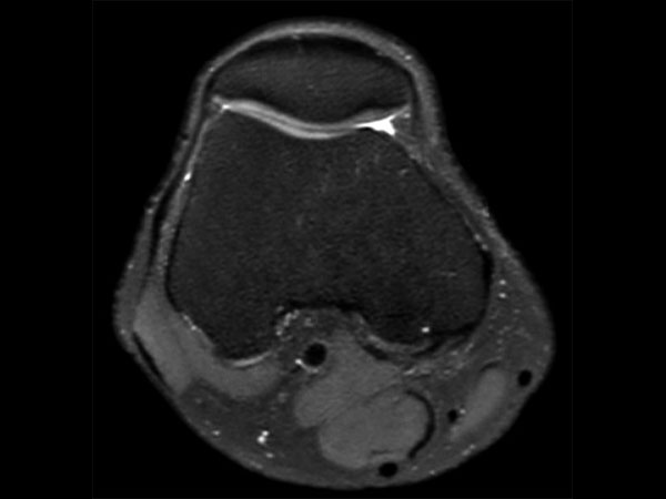 MSK View PDw SPAIR Axial Reformat